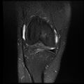 Anterior cruciate ligament tear with posteromedial corner injury, bucket-handle meniscal tear and chondral delamination (Radiopaedia 75501-86744 Coronal PD fat sat 8).jpg