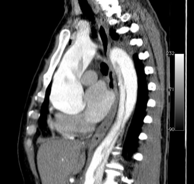 File:Aortic dissection - Stanford type A (Radiopaedia 29247-29659 C 27).jpg