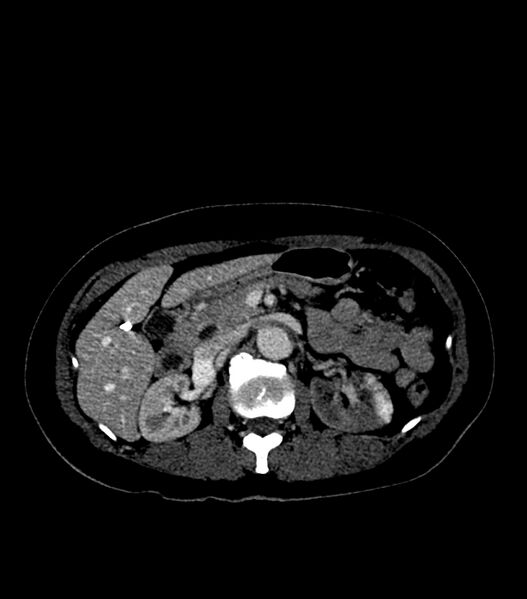 File:Aortic dissection with renal ischemia (Radiopaedia 76573-88338 B 33).jpg