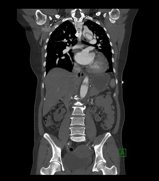 File:Aortic dissection with renal ischemia (Radiopaedia 76573-88338 C 17).jpg