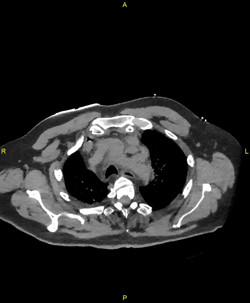 Aortic rupture (Radiopaedia 88822-105594 Axial non-contrast 37).jpg