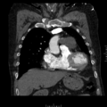Aorto-coronary bypass graft aneurysms (Radiopaedia 40562-43157 B 13).png