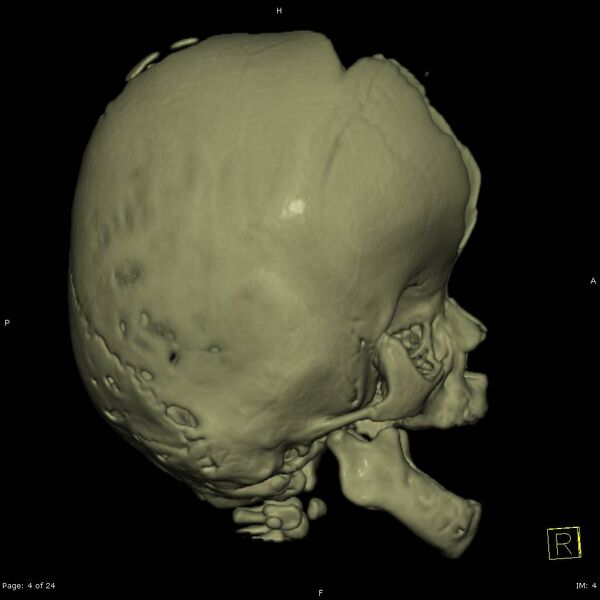 File:Apert syndrome with syndactyly (Radiopaedia 10315-10834 3D MPR bone window 4).jpg