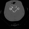 Apical pneumothorax on cervical spine CT (Radiopaedia 45343-49368 Axial bone window 47).jpg