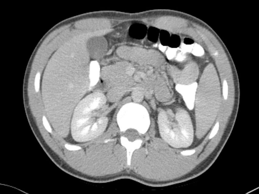 Appendicitis and incidental foregut duplication cyst (Radiopaedia 52962-58916 A 13).jpg