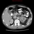 Appendicitis and renal cell carcinoma (Radiopaedia 17063-16760 A 17).jpg