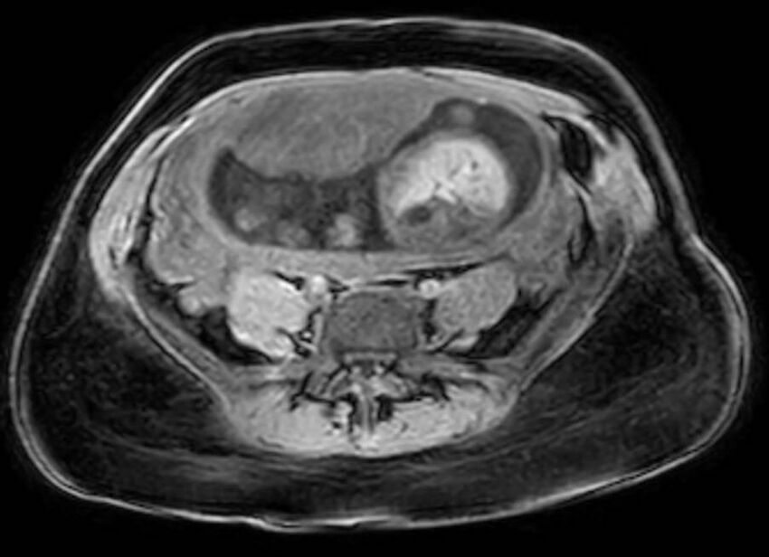 Appendicitis in gravida (MRI) (Radiopaedia 89433-106395 Axial DIXON 96).jpg