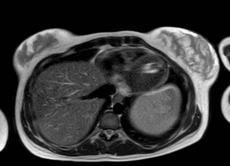 File:Appendicitis in gravida (MRI) (Radiopaedia 89433-106395 Axial T2 3).jpg