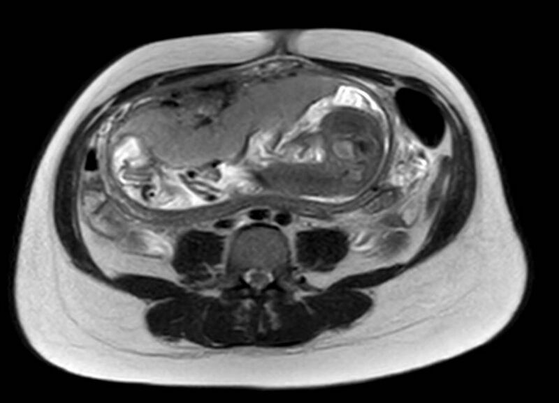 File:Appendicitis in gravida (MRI) (Radiopaedia 89433-106395 Axial T2 40).jpg