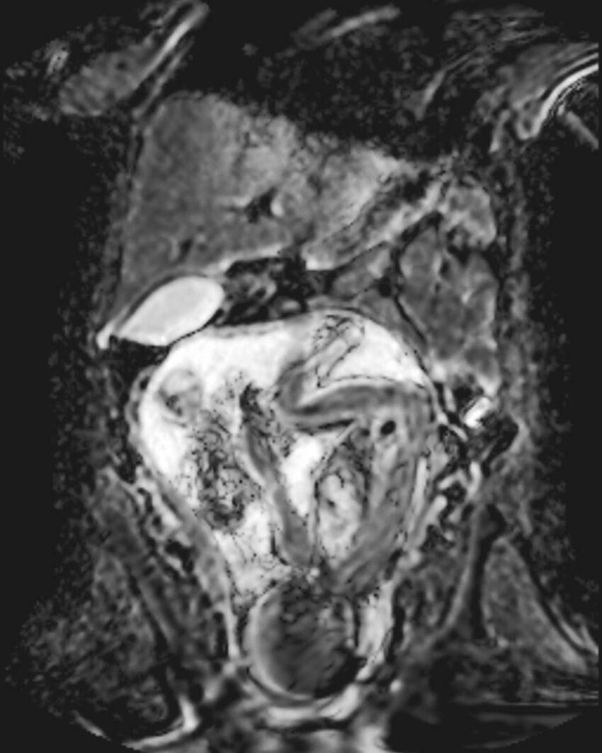Appendicitis in gravida (MRI) (Radiopaedia 89433-106395 Coronal ADC 23).jpg
