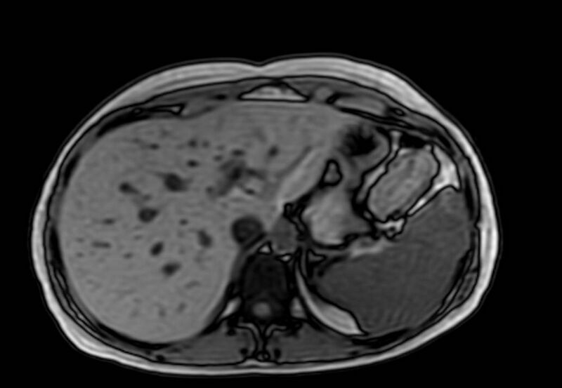 File:Appendicitis in gravida (MRI) (Radiopaedia 89433-106395 D 10).jpg