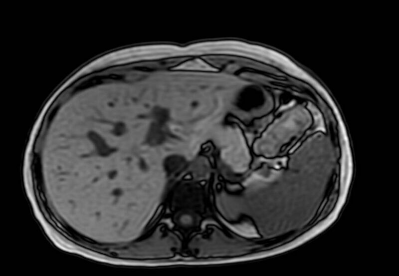 File:Appendicitis in gravida (MRI) (Radiopaedia 89433-106395 D 11).jpg