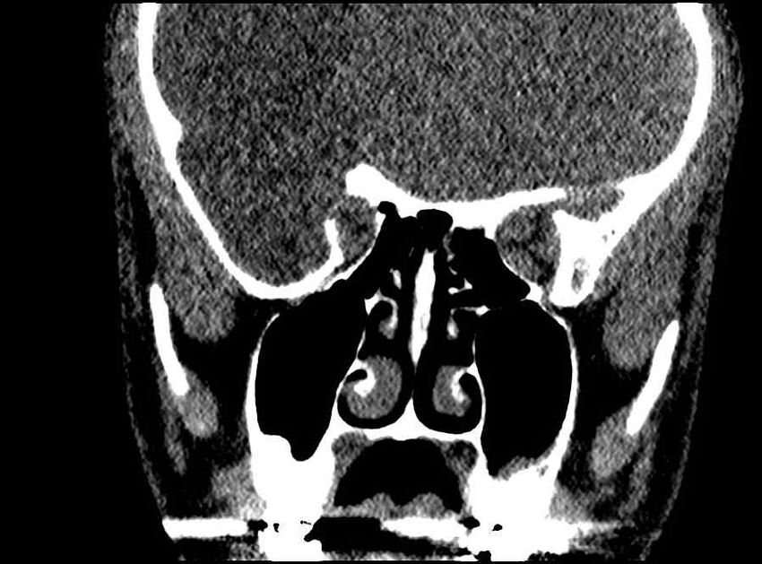 Arachnoid cyst- extremely large (Radiopaedia 68741-78450 Coronal bone window 38).jpg
