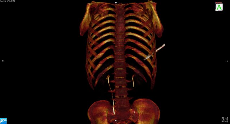 File:Arrow injury to the chest (Radiopaedia 75223-86321 3D bone 2).jpg
