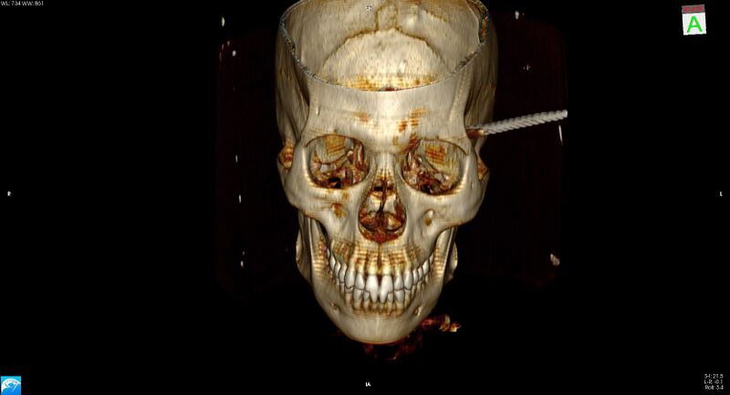 File:Arrow injury to the head (Radiopaedia 75266-86388 3D vertical 6).jpg