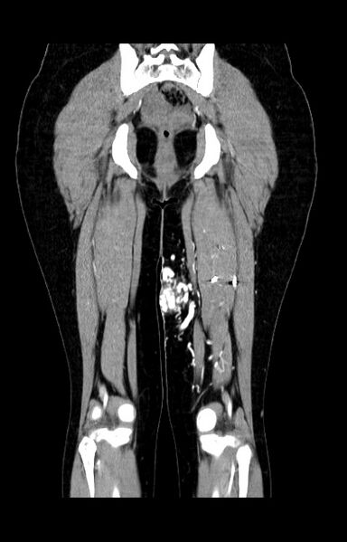 File:Arteriovenous malformation of the thigh (Radiopaedia 14948-14883 C+ arterial phase 18).jpg