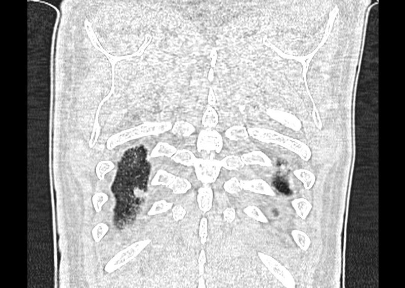 File:Asbestos pleural placques (Radiopaedia 57905-64872 Coronal lung window 276).jpg
