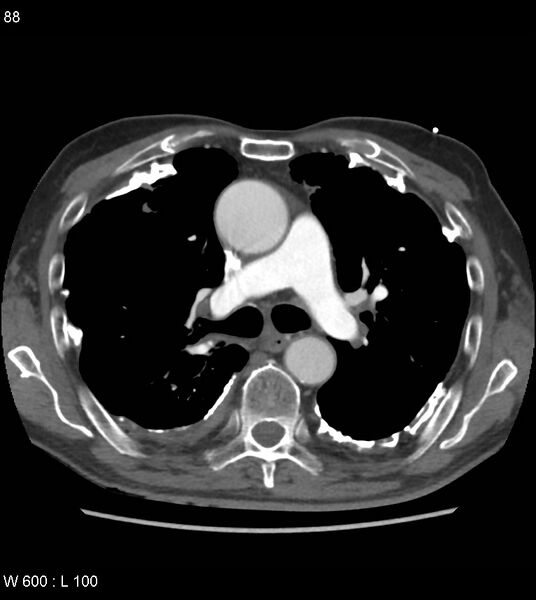 File:Asbestos related lung and pleural disease (Radiopaedia 14377-14301 D 24).jpg