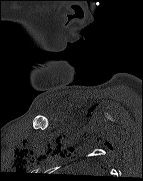 File:Atlanto-occipital dissociation - Traynelis type 1 (Radiopaedia 87570-103948 Sagittal bone window 8).jpg