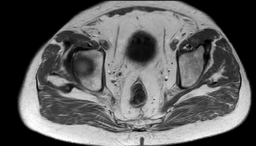 Atypical lipomatous tumor - thigh (Radiopaedia 68975-78734 Axial T1 98).jpg