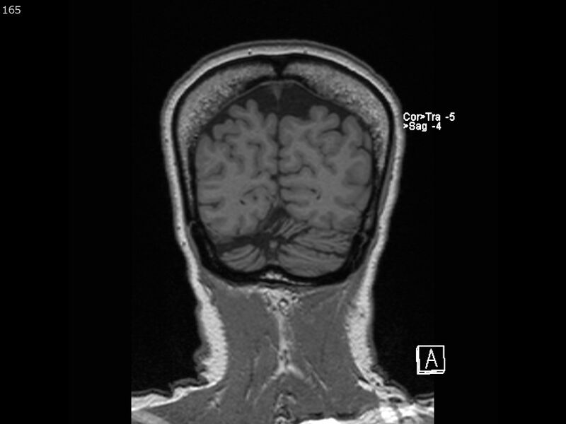 File:Atypical meningioma - intraosseous (Radiopaedia 64915-74572 Coronal T1 165).jpg
