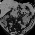 Autosomal dominant polycystic kidney disease (Radiopaedia 36539-38101 Coronal non-contrast 11).jpg