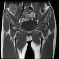 Avascular necrosis of the hip (Radiopaedia 29563-30067 Coronal T1 4).jpg