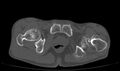 Avascular necrosis of the left hip (Radiopaedia 75068-86125 Axial bone window 76).jpg