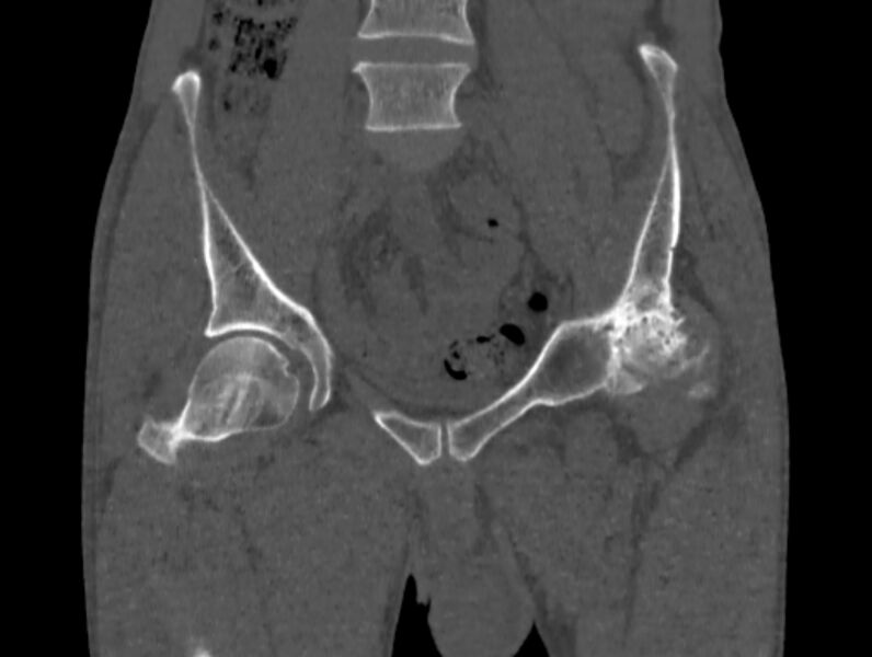File:Avascular necrosis of the left hip (Radiopaedia 75068-86125 Coronal bone window 12).jpg