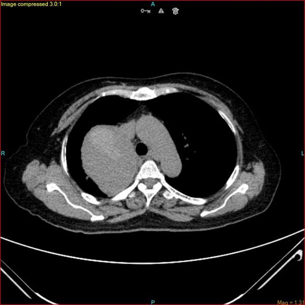 File:Azygos vein aneurysm (Radiopaedia 77824-90130 A 20).jpg