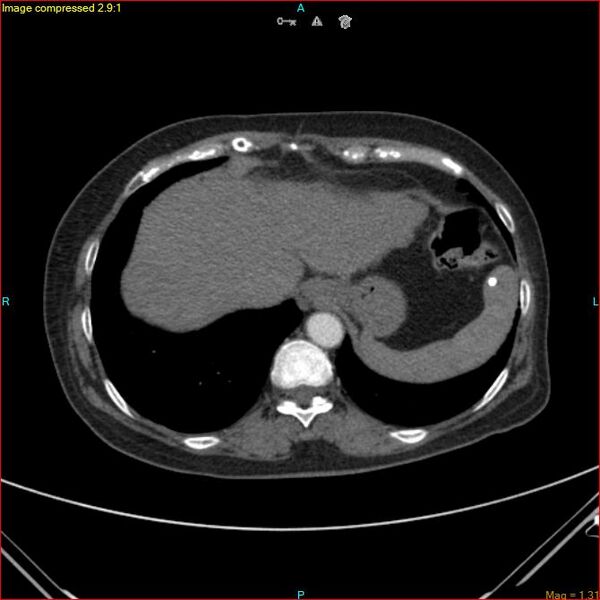 File:Azygos vein aneurysm (Radiopaedia 77824-90130 B 45).jpg