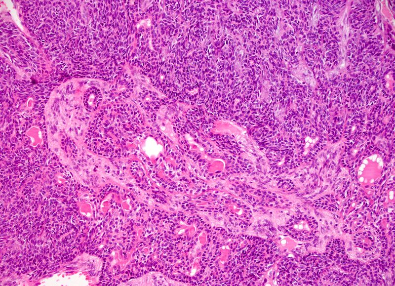 File:Basal cell adenoma - salivary gland (Radiopaedia 43989-47511 100x H&E 1).jpg
