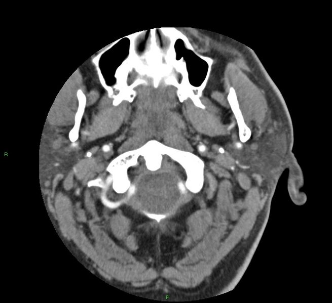 File:Basal ganglia hemorrhage (Radiopaedia 58763-65985 D 6).jpg