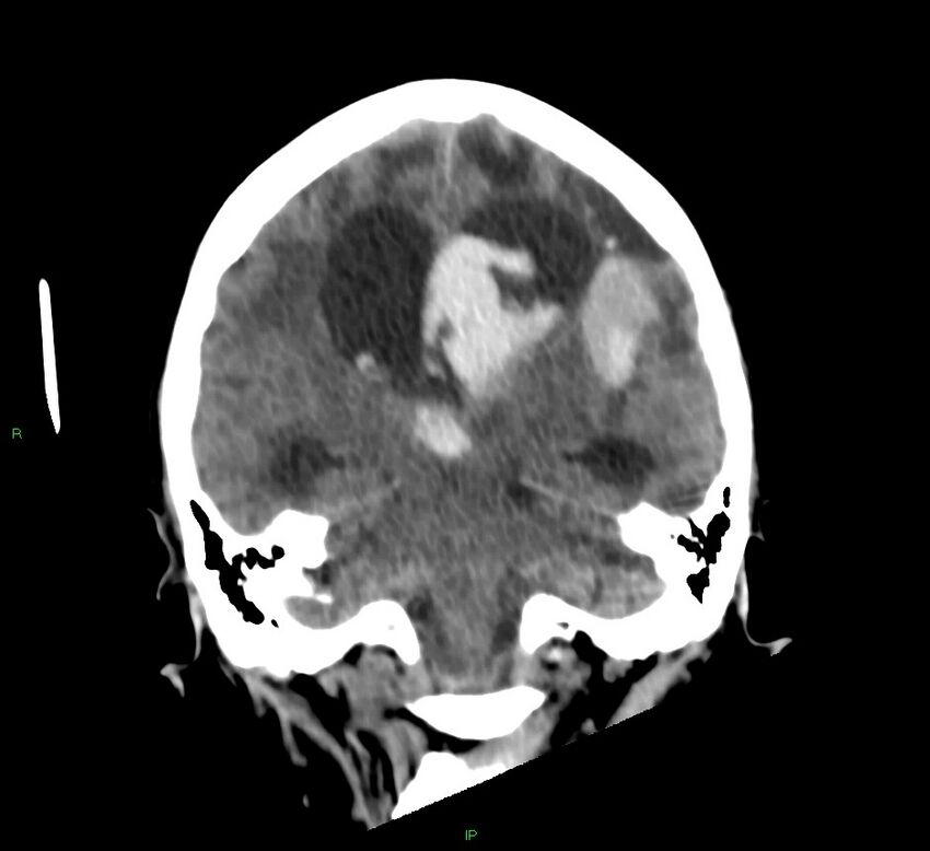Basal ganglia hemorrhage (Radiopaedia 58766-65988 Coronal non-contrast 32).jpg