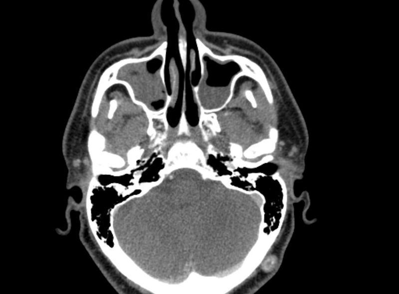 File:Benign mixed salivary tumor of the parotid gland (Radiopaedia 35261-36792 A 9).jpg
