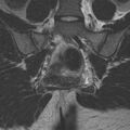Bicornuate uterus (Radiopaedia 24677-24949 Coronal T2 18).jpg