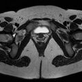 Bicornuate uterus (Radiopaedia 72135-82643 Axial T2 19).jpg