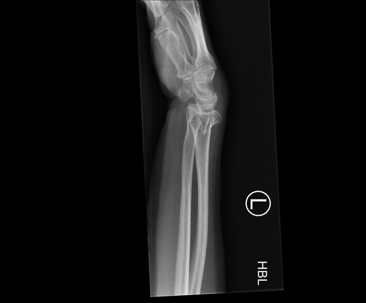 File:Bilateral Colles fractures (Radiopaedia 86290-102312 Lateral 1).jpg