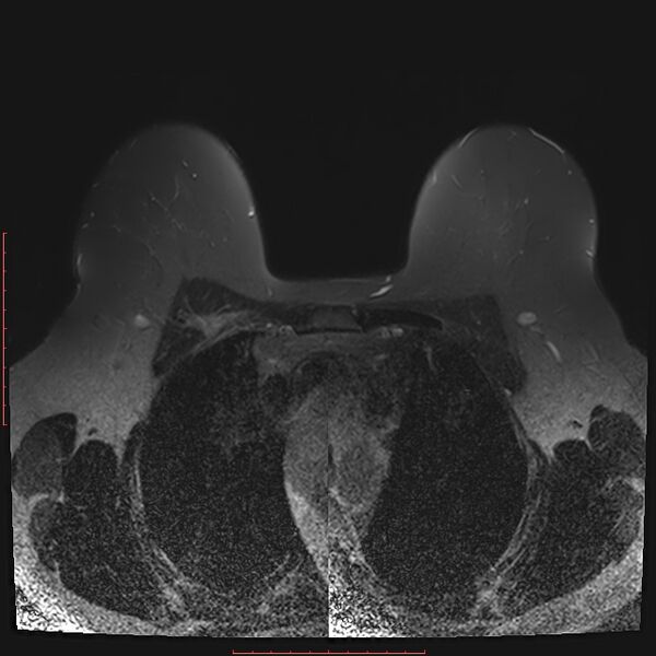 File:Bilateral breast implant rupture (Radiopaedia 24761-25027 T2 fat sat 11).jpg