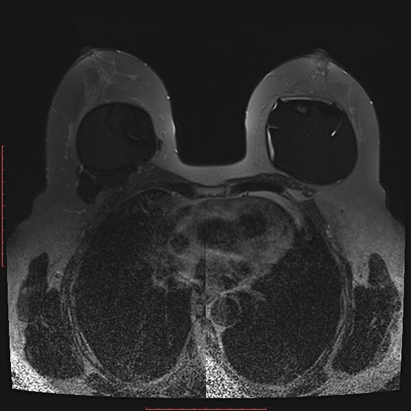 File:Bilateral breast implant rupture (Radiopaedia 24761-25027 T2 fat sat 18).jpg
