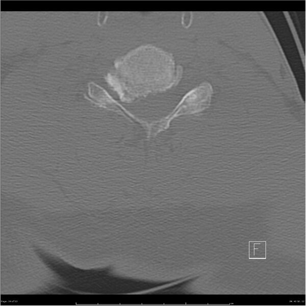 File:Bilateral cervical ribs (Radiopaedia 25868-26017 Axial bone window 34).jpg
