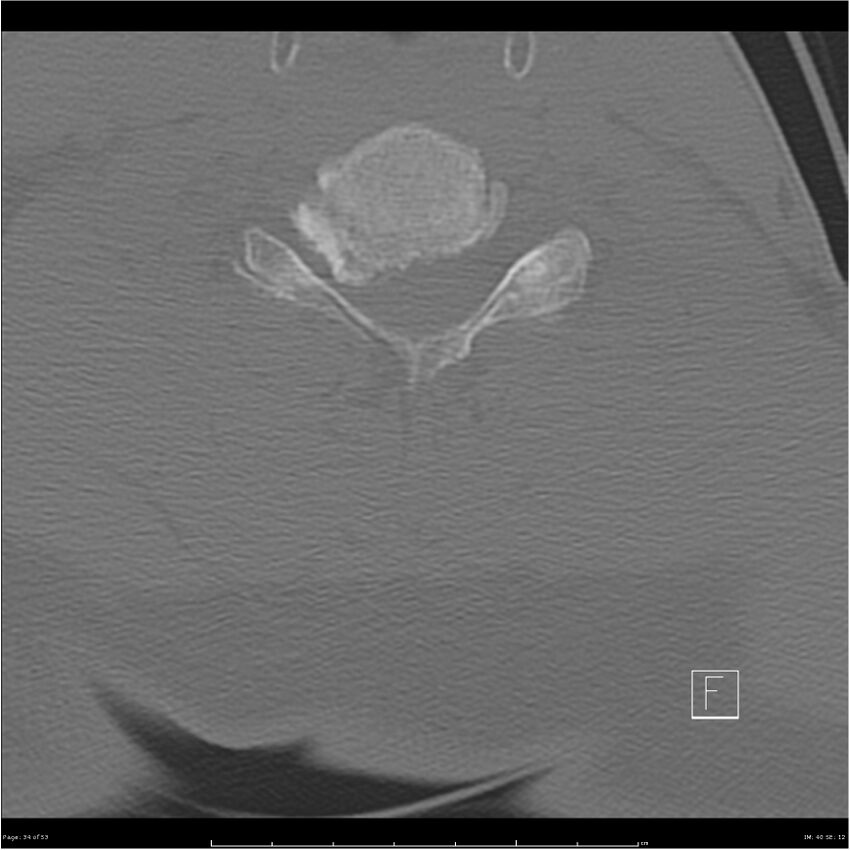 Bilateral cervical ribs (Radiopaedia 25868-26017 Axial bone window 34).jpg