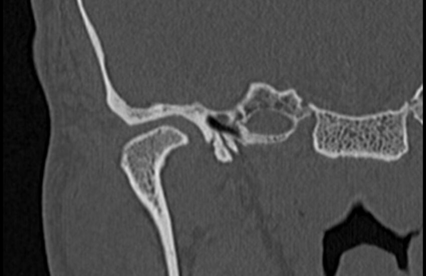 Bilateral cholesteatoma (Radiopaedia 54898-61172 Coronal bone window 8).jpg