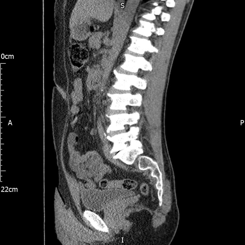 Bilateral medullary nephrocalcinosis with ureteric calculi (Radiopaedia 71269-81569 C 54).jpg
