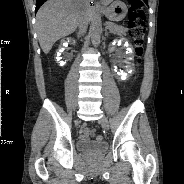 File:Bilateral medullary nephrocalcinosis with ureteric calculi (Radiopaedia 71269-81569 Coronal non-contrast 41).jpg