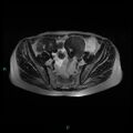 Bilateral ovarian fibroma (Radiopaedia 44568-48293 Axial T2 9).jpg