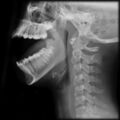 Bilateral temporomandibular joint dislocation (Radiopaedia 6271).jpg