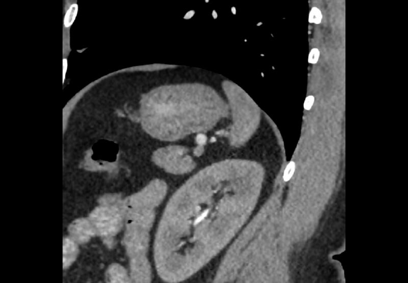 File:Bilateral urolithiasis with incidentally detected splenic artery aneurysm and left inferior vena cava (Radiopaedia 44467-48127 Ob. Sag. C+ Art. 7).jpg