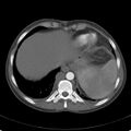 Biliary necrosis - liver transplant (Radiopaedia 21876-21846 A 9).jpg