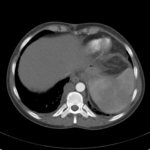 File:Biliary necrosis - liver transplant (Radiopaedia 21876-21846 A 9).jpg